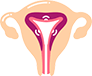 Ablação Endometrial Ablação Endometrial
